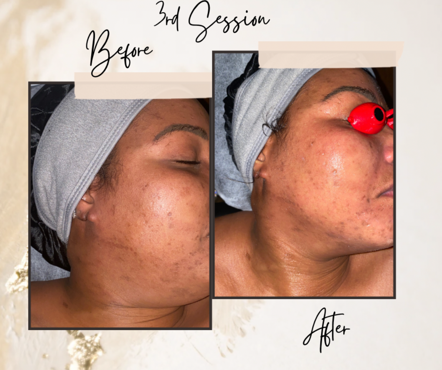 Red Light Therapy Body Treatment or LED w/ Microcurrent Skin Therapy- Scar Reduction, Anti-Aging/Rejuvenation Treatment Services