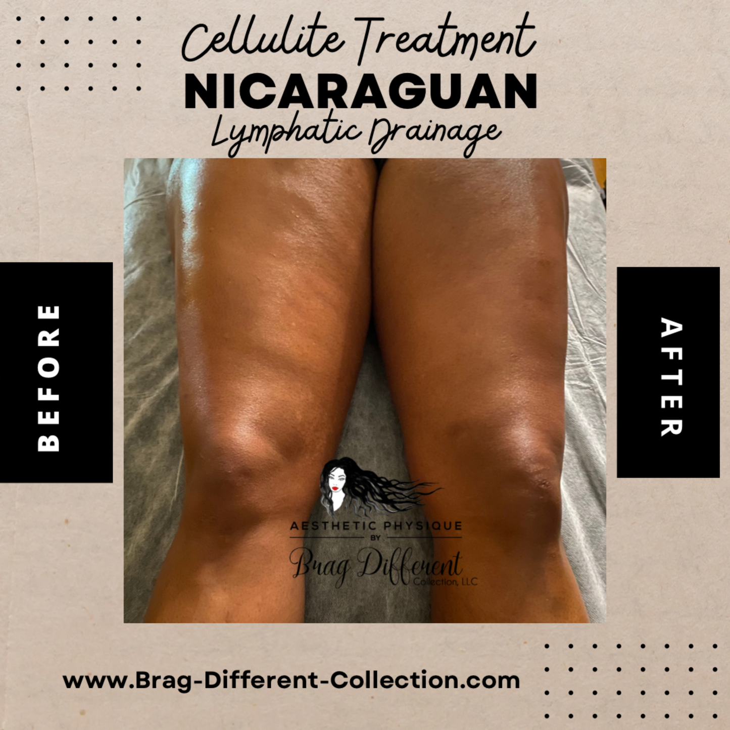 Nicaraguan Lymphatic Drainage Massage, (Inflammation Reduction) Cosmetic & Medical Post Surgical Care