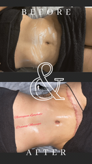Nicaraguan Lymphatic Drainage Massage & Postop Care Services